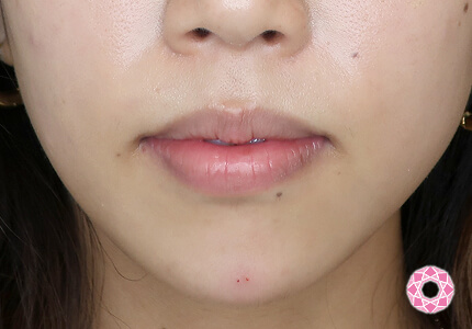 年代：20代 施術名：ジュビダーム 施術後｜【公式】東京形成美容外科