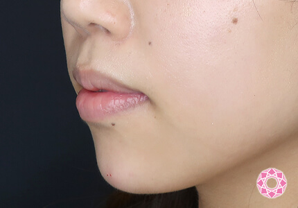 年代：20代 施術名：ジュビダーム 施術後｜【公式】東京形成美容外科