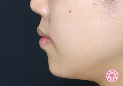 年代：20代 施術名：ジュビダーム 施術後｜【公式】東京形成美容外科