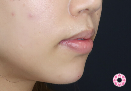 年代：20代 施術名：ジュビダーム 施術後｜【公式】東京形成美容外科