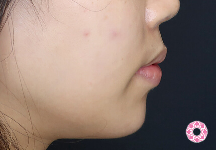 年代：20代 施術名：ジュビダーム 施術後｜【公式】東京形成美容外科