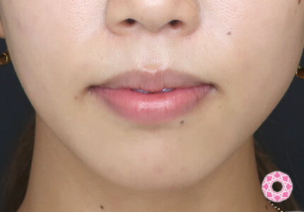 年代：20代 施術名：ジュビダーム 施術前｜【公式】東京形成美容外科