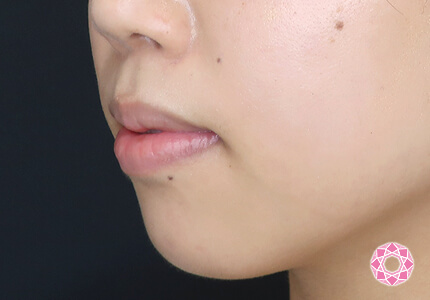 年代：20代 施術名：ジュビダーム 施術前｜【公式】東京形成美容外科