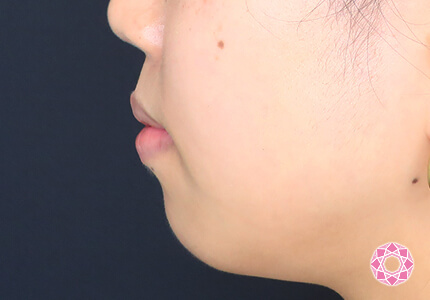 年代：20代 施術名：ジュビダーム 施術前｜【公式】東京形成美容外科