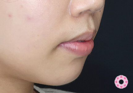 年代：20代 施術名：ジュビダーム 施術前｜【公式】東京形成美容外科