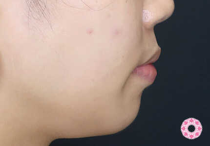 年代：20代 施術名：ジュビダーム 施術前｜【公式】東京形成美容外科