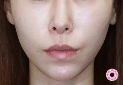 年代：30代 施術名：美肌スレッド 施術後｜【公式】東京形成美容外科