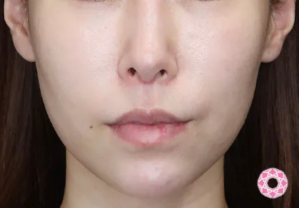 年代：30代 施術名：美肌スレッド 施術前｜【公式】東京形成美容外科