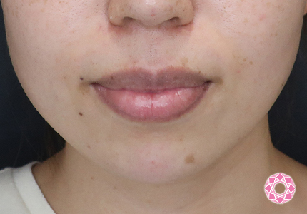 年代：30代 施術名：ジュビダーム 施術後｜【公式】東京形成美容外科