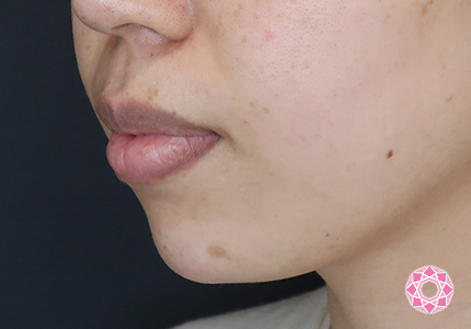 年代：30代 施術名：ジュビダーム 施術後｜【公式】東京形成美容外科