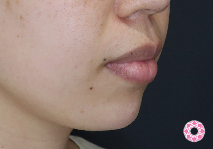 年代：30代 施術名：ジュビダーム 施術後｜【公式】東京形成美容外科