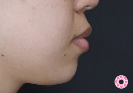 年代：30代 施術名：ジュビダーム 施術後｜【公式】東京形成美容外科