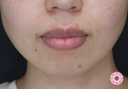 年代：30代 施術名：ジュビダーム 施術前｜【公式】東京形成美容外科