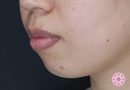 年代：30代 施術名：ジュビダーム 施術前｜【公式】東京形成美容外科