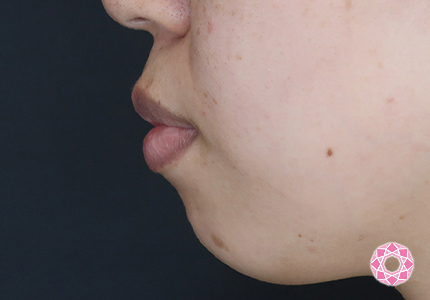 年代：30代 施術名：ジュビダーム 施術前｜【公式】東京形成美容外科