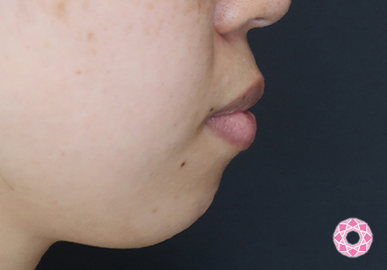 年代：30代 施術名：ジュビダーム 施術前｜【公式】東京形成美容外科