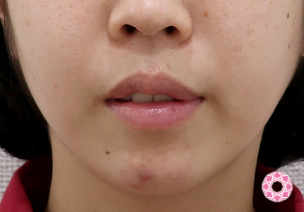 年代：20代 施術名：1DayクイックEライン 施術後｜【公式】東京形成美容外科