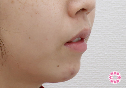 年代：20代 施術名：1DayクイックEライン 施術後｜【公式】東京形成美容外科