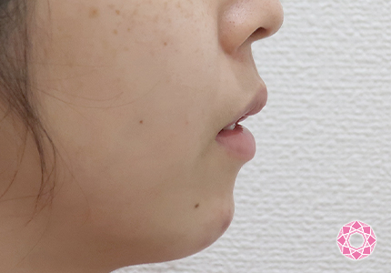 年代：20代 施術名：1DayクイックEライン 施術後｜【公式】東京形成美容外科