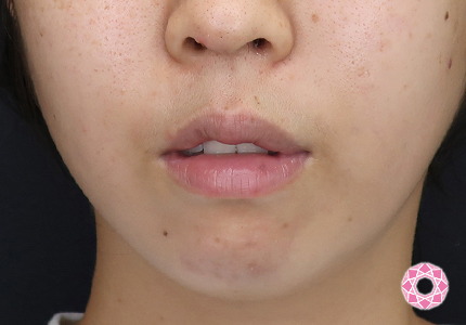 年代：20代 施術名：1DayクイックEライン 施術前｜【公式】東京形成美容外科