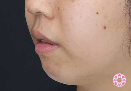 年代：20代 施術名：1DayクイックEライン 施術前｜【公式】東京形成美容外科