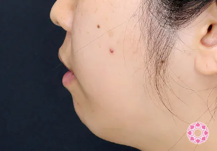 年代：20代 施術名：1DayクイックEライン 施術前｜【公式】東京形成美容外科