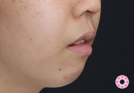 年代：20代 施術名：1DayクイックEライン 施術前｜【公式】東京形成美容外科