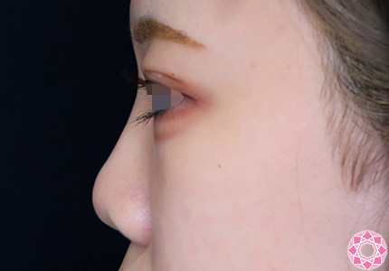 年代：10代 施術名：プチ隆鼻術（ヒアルロン酸） 施術後｜【公式】東京形成美容外科