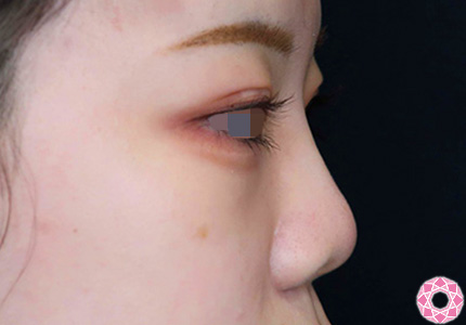 年代：10代 施術名：プチ隆鼻術（ヒアルロン酸） 施術後｜【公式】東京形成美容外科