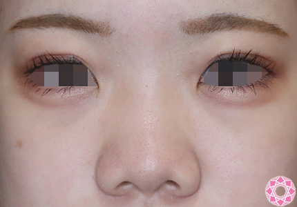 年代：10代 施術名：プチ隆鼻術（ヒアルロン酸） 施術前｜【公式】東京形成美容外科