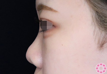 年代：10代 施術名：プチ隆鼻術（ヒアルロン酸） 施術前｜【公式】東京形成美容外科