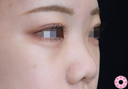 年代：10代 施術名：プチ隆鼻術（ヒアルロン酸） 施術前｜【公式】東京形成美容外科