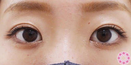 年代：20代 施術名：二重埋没法 施術後｜【公式】東京形成美容外科