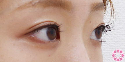 年代：20代 施術名：二重埋没法 施術後｜【公式】東京形成美容外科