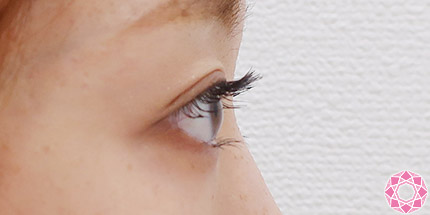 年代：20代 施術名：二重埋没法 施術後｜【公式】東京形成美容外科