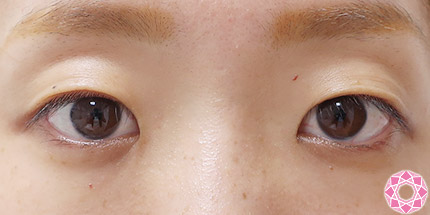 年代：20代 施術名：二重埋没法 施術前｜【公式】東京形成美容外科