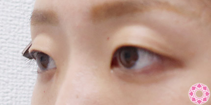 年代：20代 施術名：二重埋没法 施術前｜【公式】東京形成美容外科