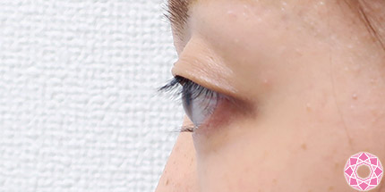 年代：20代 施術名：二重埋没法 施術前｜【公式】東京形成美容外科