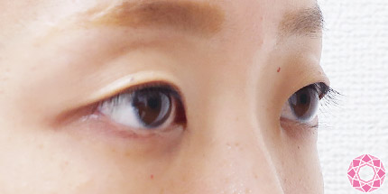 年代：20代 施術名：二重埋没法 施術前｜【公式】東京形成美容外科