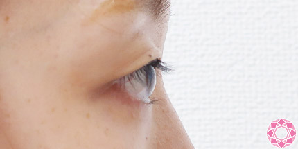 年代：20代 施術名：二重埋没法 施術前｜【公式】東京形成美容外科