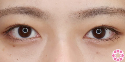 年代：10代 施術名：二重埋没法 施術後｜【公式】東京形成美容外科