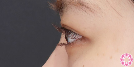 年代：10代 施術名：二重埋没法 施術後｜【公式】東京形成美容外科