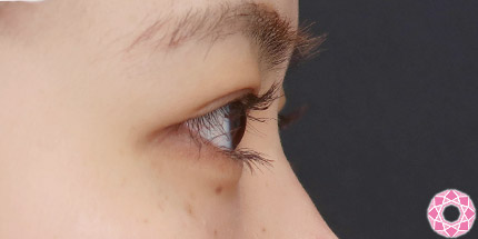 年代：10代 施術名：二重埋没法 施術後｜【公式】東京形成美容外科