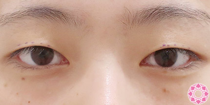 年代：10代 施術名：二重埋没法 施術前｜【公式】東京形成美容外科