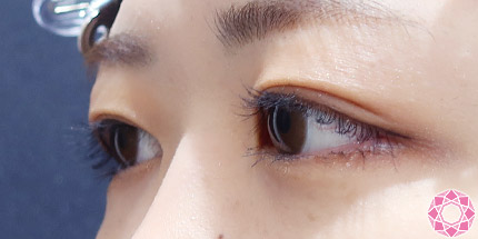 年代：20代 施術名：二重埋没法 施術後｜【公式】東京形成美容外科