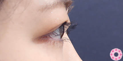 年代：20代 施術名：二重埋没法 施術後｜【公式】東京形成美容外科