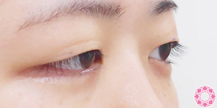 年代：20代 施術名：二重埋没法 施術前｜【公式】東京形成美容外科