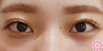 年代：20代 施術名：二重埋没法 施術後｜【公式】東京形成美容外科