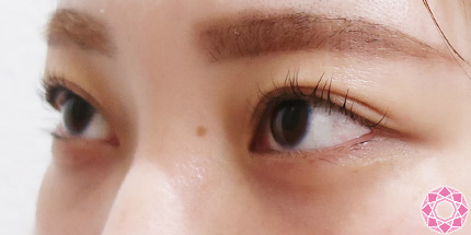 年代：20代 施術名：二重埋没法 施術後｜【公式】東京形成美容外科