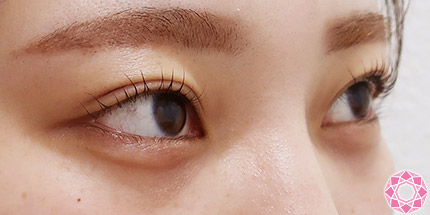 年代：20代 施術名：二重埋没法 施術後｜【公式】東京形成美容外科